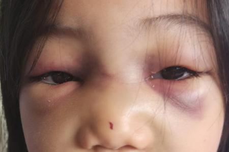 Girl, 7, bruised after fall in school bus 