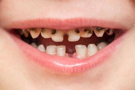 About 1 in 2 children here has tooth decay by kindergarten age