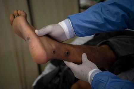 'Crying all the time': Monkeypox patients reveal psychological scars