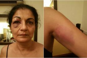 Mrs Puran Kaur showing the injuries that she suffered when she was dragged by snatch thieves in Bangkok, Thailand. 