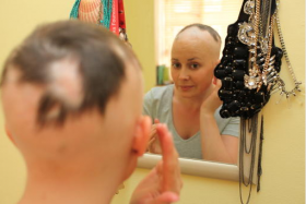 Miss Chloe Moore, 29, suffers from alopecia areata, which causes her to have bald spots. 