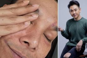 Actor Ryan Lian shared close-ups of his three scars: one by the side of his lip, one on his chin and another around his left eyebrow. 